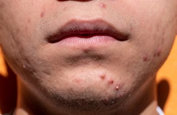 Truly Clear chin acne