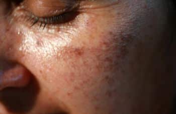 Does the Sun Help Acne; Everything you Should Know – Truly Clear