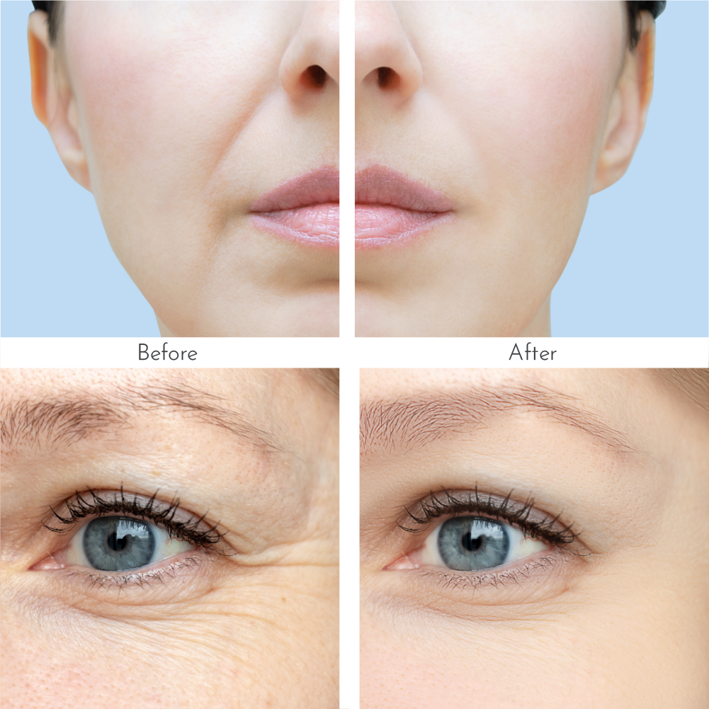 Truly Clear Wrinkle Fighting Hyaluronic Patches