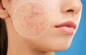 Truly Clear pimples on cheeks