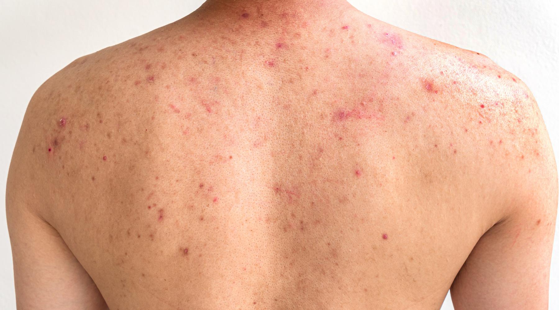 Close-up of a bodybuilder's back with acne, highlighting the common issue of body acne caused by sweat and friction from intense workouts. Truly Clear acne bar helps treat and prevent body breakouts for athletes and gym-goers.