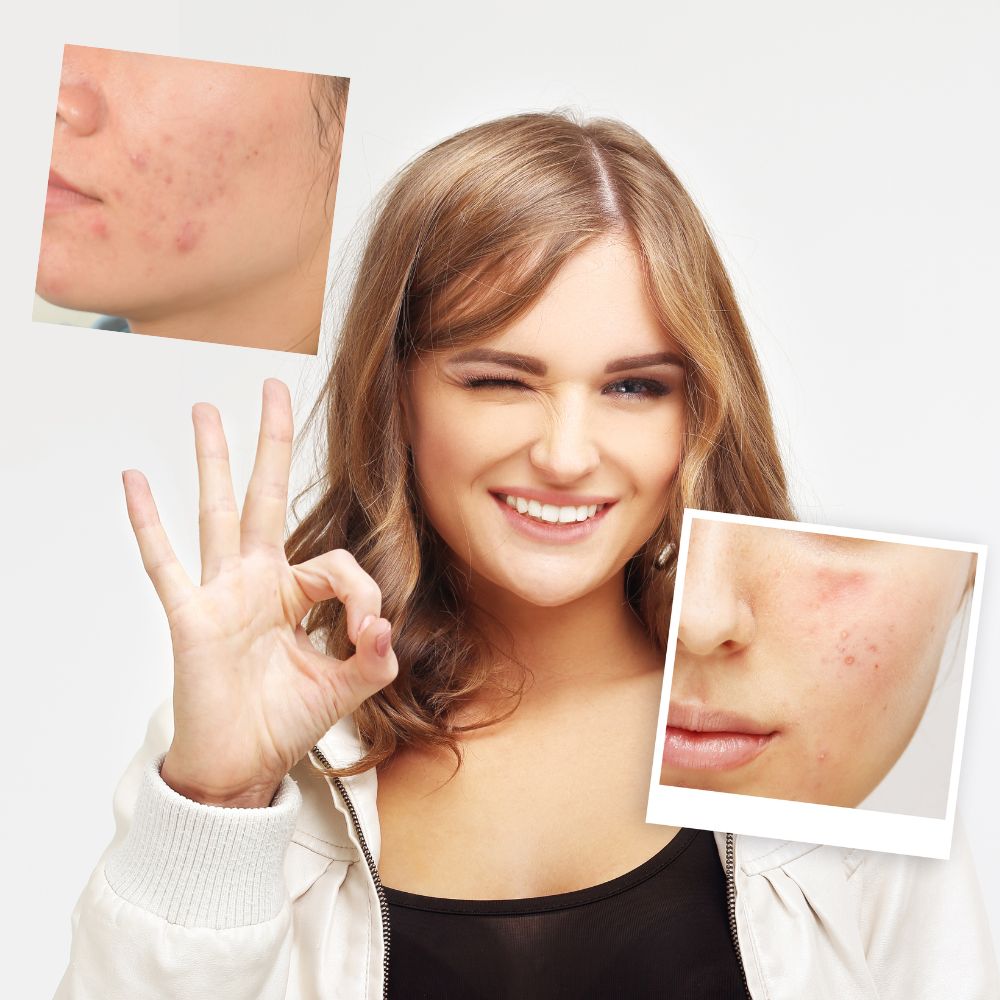 Truly Clear's Plant-Based Hydrocolloid Patches: Your Overnight Solution for Acne Anywhere