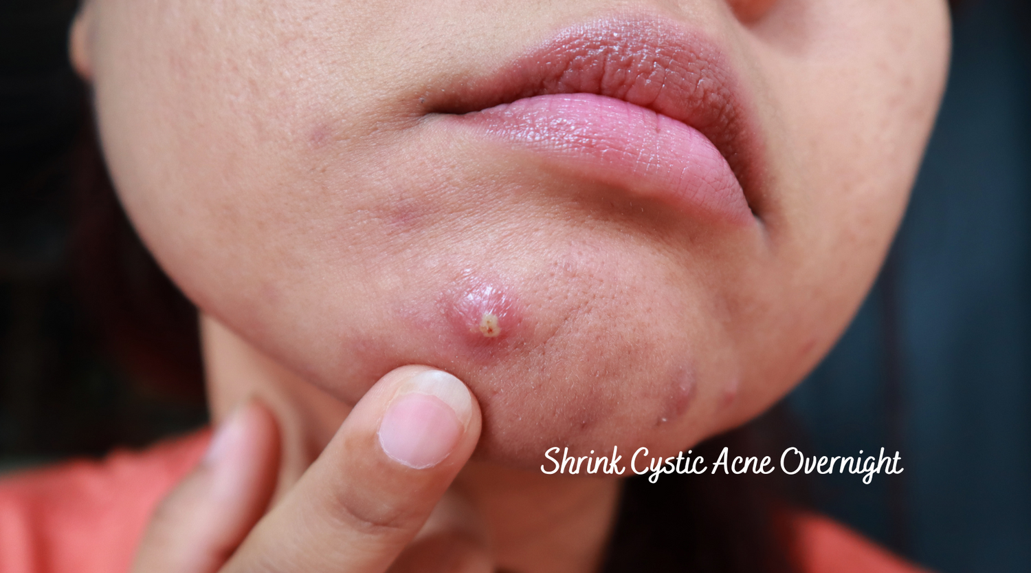 How to Shrink a Cystic Pimple Overnight